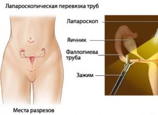 Перевязка маточных труб: плюсы, минусы, шансы забеременеть после стерилизации Возможно ли забеременеть после стерилизации