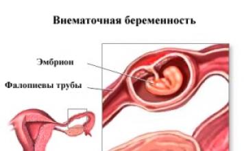Причины внематочной беременности у женщин, признаки и развитие на ранних сроках Бывают ли при внематочной беременности нарушения цикла