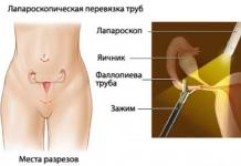 Перевязка маточных труб: плюсы, минусы, шансы забеременеть после стерилизации Возможно ли забеременеть после стерилизации